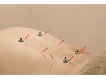 てらの鍼灸院 整体院/体の施術コース3