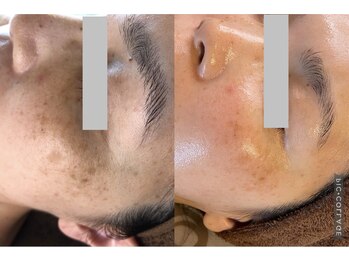 キレイ(KIREI)/before　＆　after