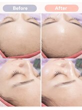 キアラ 麻布十番(Kiara)/顔ワックス脱毛/麻布十番/毛穴
