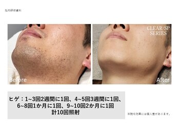 脱毛サロン　ｓｉｍｐｌｅ＋【6月NEW OPEN（予定）】の写真/【メンズ専門】同性オーナーによる施術で安心◎ヒゲもVIOも、気になるムダ毛はプロにお任せ！