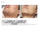 脱毛サロン　ｓｉｍｐｌｅ＋【6月NEW OPEN（予定）】の写真/【メンズ専門】同性オーナーによる施術で安心◎ヒゲもVIOも、気になるムダ毛はプロにお任せ！