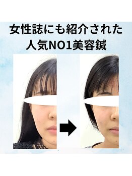 ゆず鍼灸整骨院/GINGERに紹介された美容鍼