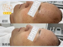 キャス(KYAS)/[ハーブピーリング]ニキビケア◎