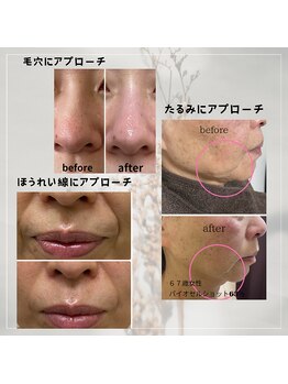 クレビア(Crebia)/バイオセルショット導入エステ