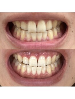 エクシアホワイトニング 草津店/ホワイトニングビフォーアフター