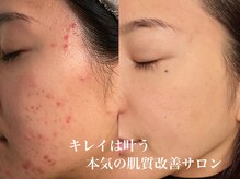 イリマレイサロン(iLima Lei SALON)/step upトリートメント