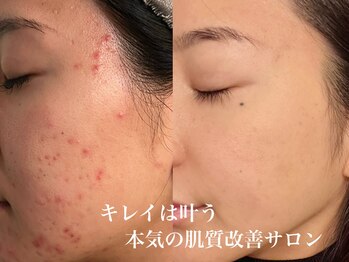 イリマレイサロン(iLima Lei SALON)/step upトリートメント