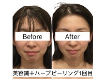 アネモネ 心斎橋院/美容鍼＋ハーブピーリング1回目