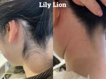 リリーライオン(Lily Lion)の雰囲気（イベント前に［うなじ背中］ワックス脱毛で綺麗に/後ろ姿も完璧）
