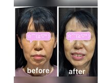 ココスタイルビューティー(COCOSTYLE beauty)の雰囲気（光フェイシャル、水滴リフティングのWケア!一回の結果です）