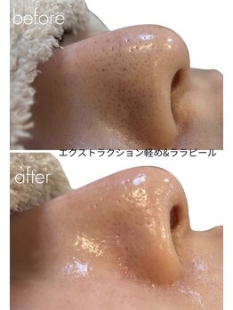 ジーンバイピエル 中野店(gene by PIEL)/#毛穴ケア#ピーリング#ワックス