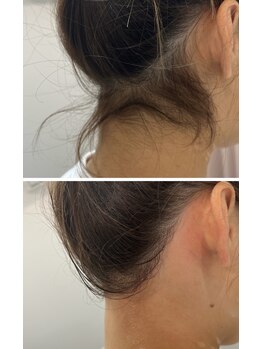 サロン ド ワイシス(Salon de ysis)の写真/【大人気メニュー☆うなじシュガーリング】髪の毛をアップにされる方必見！周りと差がつく横姿、後ろ姿に♪