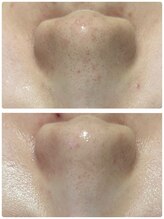 ラン(Ran)/毛穴、黒くなっていませんか？