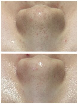 ラン(Ran)/毛穴、黒くなっていませんか?