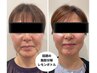 速攻で小顔効果◎【脂肪分解♪レモンボトル+毛穴洗浄】
