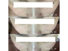 ブランシェ 金沢店 × 椿/シミケア　『40代お客様』