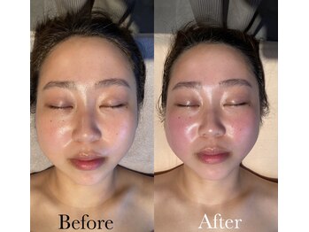 イニ(1n1)/小顔コルギ