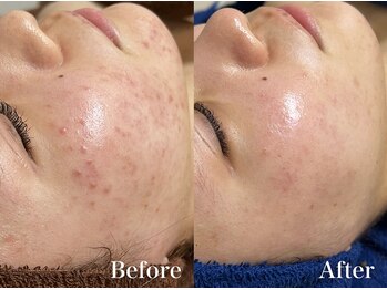 マシェ バイ マユ(Mache by Mayu)/頑固なニキビケアはこのハーブ☆