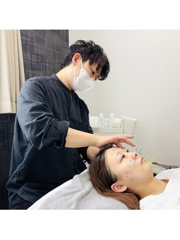 フラット(flat)/施術風景/小顔美容鍼