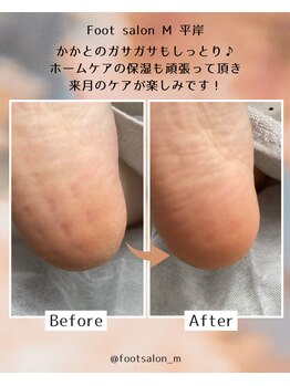 【足裏角質ケア】女性