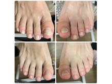 ミコ(.mico)の雰囲気(爪の脱落、義爪作成可能。)