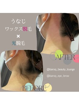 バロックビューティーラウンジ(BAROQ beauty lounge)/うなじ脱毛