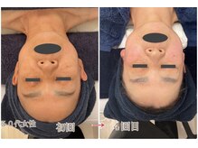 芹花 鹿の子台 (SERIKA)/くすみでお悩みの方に