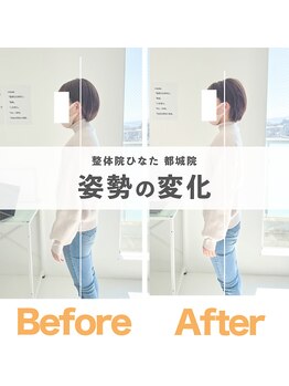 整体院ひなた 都城院/【姿勢の変化】