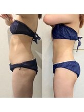 BS AQUA Beauty 人気痩身ボディコース♪