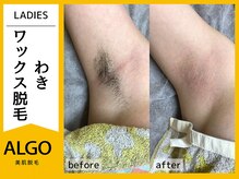 アルゴ 小松店(ALGO)/アルゴ式ワックス脱毛
