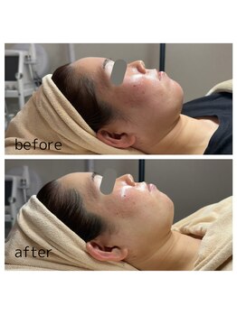 エピリア(Epilear)/PLAWAVE &nbsp;肌質改善コース