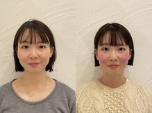 ストリ(STRI)/美容鍼before、after