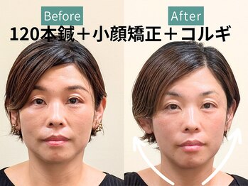 カンワ美容鍼灸院(KANWA美容鍼灸院)/エラ・余白に120本美容鍼