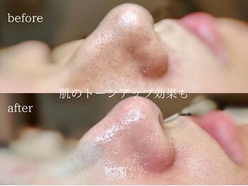 グランビューティ(Glanz Beauty)/毛穴洗浄×イオン導入×顔脱毛