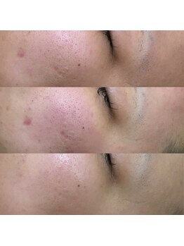 パールピーチ(total beauty place pearl peach)/ハーバルピール