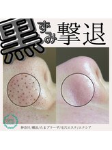 エクシア(Excia)/毛穴洗浄