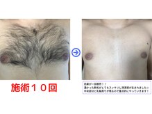 ラシンドウ 横浜鶴見店(RASHINDO)/【メンズ脱毛】《胸全体の効果》
