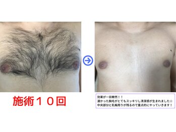 ラシンドウ 横浜鶴見店(RASHINDO)/【メンズ脱毛】《胸全体の効果》