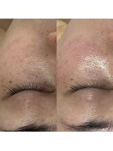 サロン ド ブラン アオヤマ(Salon de BLANC AOYAMA)/BIOPHYTO×Sonocare90min