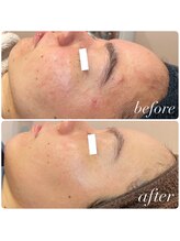 ラディエンス 多治見店/ヒト幹細胞毛穴レスエステ