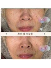 美肌研究所 絹 田辺店/月1回のお手入れでシミケア♪