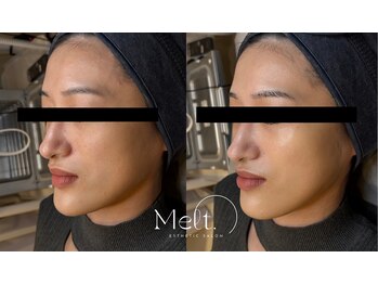 メルト 中目黒(Melt.)/*ララピール