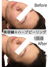 アネモネ 心斎橋院/美容鍼＋ハーブピーリング1回目