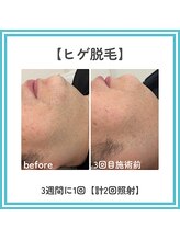トッコ 那須塩原店(tocco)/ヒゲ脱毛