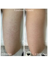 ルルボーテ(Loulou Beaute)/二の腕のザラつき