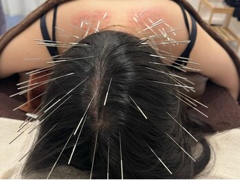 鍼さつきの写真/【顔・頭・首・肩・腰などあらゆる箇所にアプローチ】筋肉を緩め血行促進！美容鍼はどの年代の女性にも◎