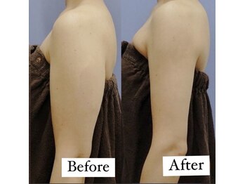 ブライダルエステ ジュエル(JEWEL)/痩身