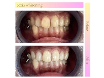 エクシアホワイトニング 郡山店/ホワイトニングビフォーアフター