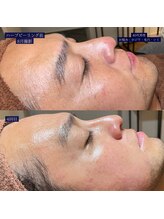 ピーディーエーサロン(PDA salon)/【ハーブピーリング】ビフォアフ