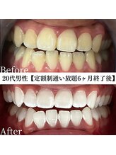 ホワイト 福岡天神店(WHITE)/ホワイトニングビフォーアフター